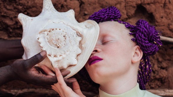 Les albinos de Mauritanie veulent se faire entendre Les albinos de Mauritanie veulent se faire entendre