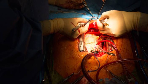 Intervention à cœur ouvert au CNC : Le père d’un patient témoigne Intervention à cœur ouvert au CNC : Le père d’un patient témoigne