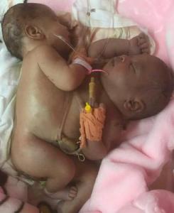 Nouakchott : Une équipe de médecins spécialistes pour sauver la vie de deux jumeaux siamois