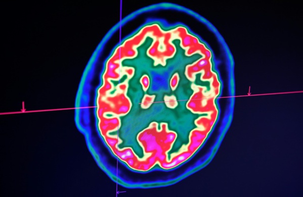 Le coronavirus semble aussi affecter le cerveau