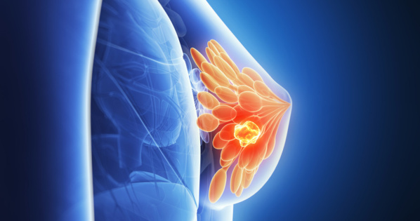 Mauritanie : le taux d'infection au cancer du sein est de 16% Mauritanie : le taux d'infection au cancer du sein est de 16%