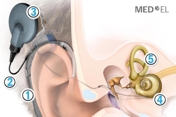 Pose pour la première fois en Mauritanie d’implants cochléaires Pose pour la première fois en Mauritanie d’implants cochléaires