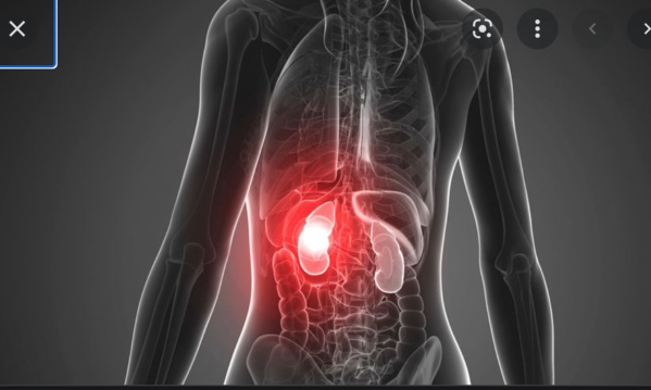 Des insuffisants rénaux manifestent devant le Ministère des Affaires sociales Des insuffisants rénaux manifestent devant le Ministère des Affaires sociales