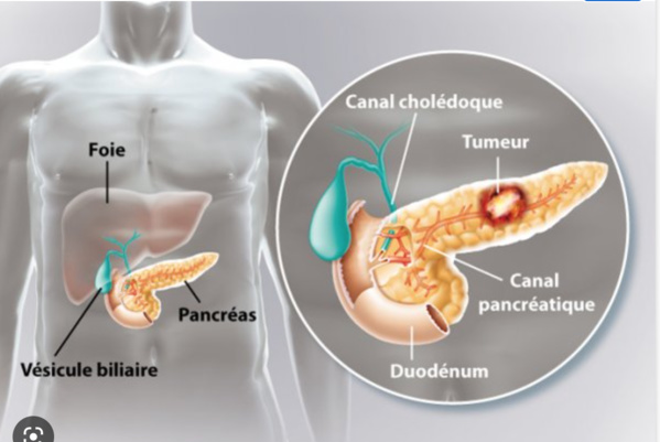 Hôpital militaire : extraction réussie d’une tumeur au pancréas d’une personne âgée (détails) Hôpital militaire : extraction réussie d’une tumeur au pancréas d’une personne âgée (détails)