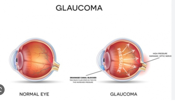 Bientôt des opérations de glaucome en Mauritanie Bientôt des opérations de glaucome en Mauritanie