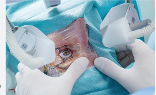 Lancement du projet d’élimination de la cécité résultant de la cataracte Lancement du projet d’élimination de la cécité résultant de la cataracte