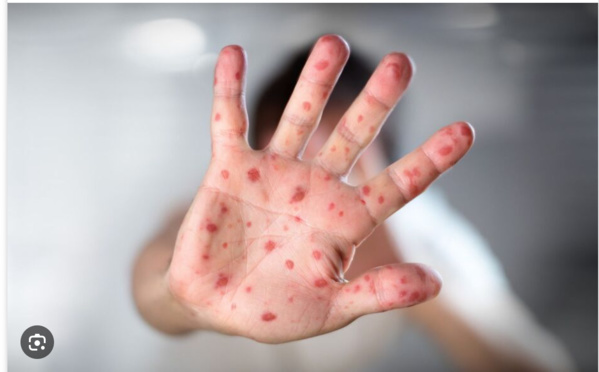 Wali du Tagant : « La situation est sous contrôle après l’apparition de cas de rougeole à Tamourt Enaaj » Wali du Tagant : « La situation est sous contrôle après l’apparition de cas de rougeole à Tamourt Enaaj »