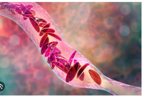 La prévalence de la drépanocytose est alarmante en Mauritanie La prévalence de la drépanocytose est alarmante en Mauritanie