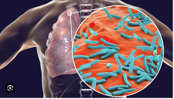 La Mauritanie célèbre la Journée mondiale de lutte contre la tuberculose