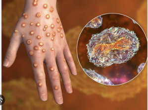 Le ministère de la santé confirme qu’aucun cas de variole n’a été enregistré Le ministère de la santé confirme qu’aucun cas de variole n’a été enregistré