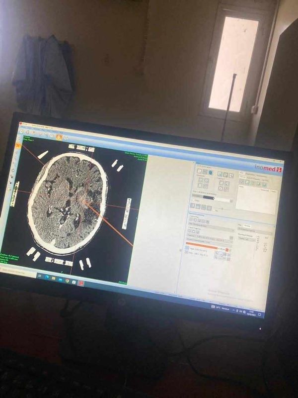 Multiples biopsies stéréotaxiques réalisées au Centre Hospitalier National de Nouakchott : une avancée rare dans la sous-région