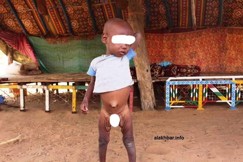 Est Mauritanie : la malnutrition frappe les enfants des Adwaba