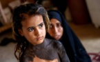Dans un village d'Irak, une fillette mise au ban à cause d'une maladie congénitale