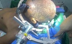 Multiples biopsies stéréotaxiques réalisées au Centre Hospitalier National de Nouakchott : une avancée rare dans la sous-région